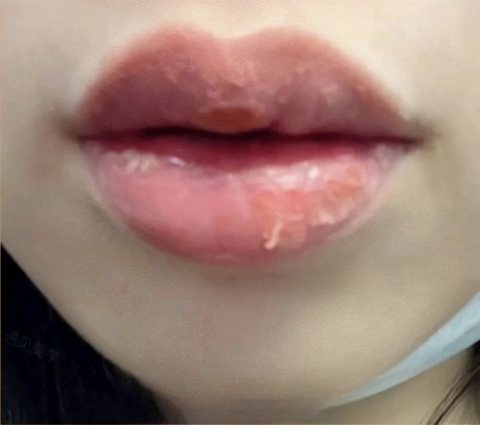 Lip blush(图13) Day 5–6