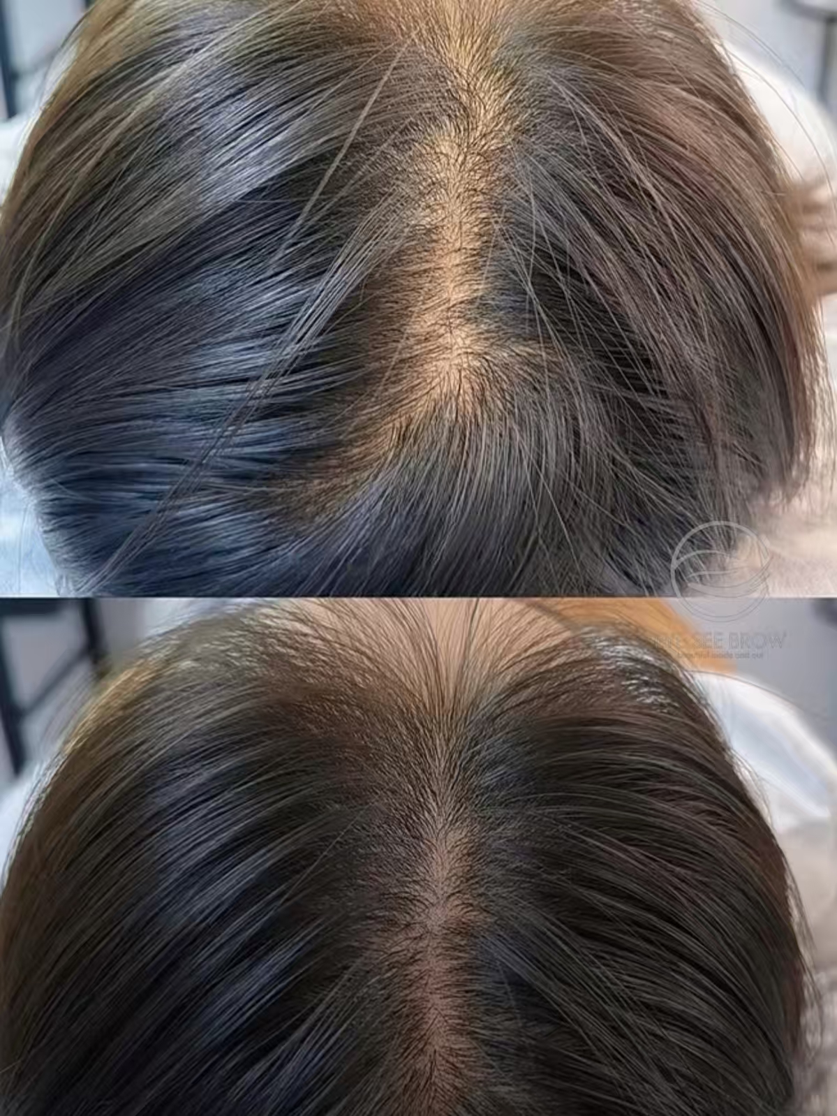 Hairline/Crown — 2